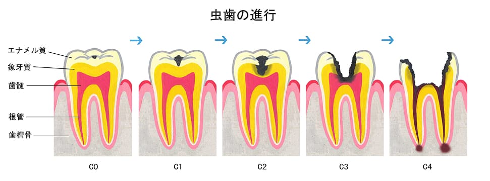 虫歯の症状と特徴