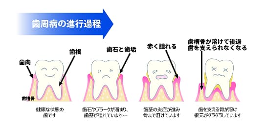 歯周病セルフチェック