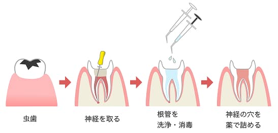 レントゲンや歯科用CTによる検査