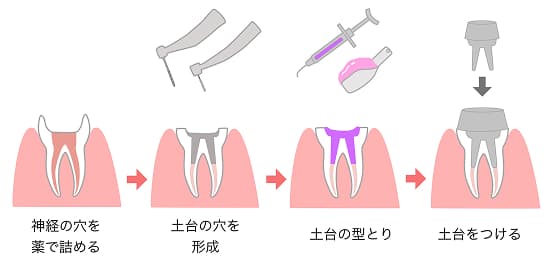 患部の除去(歯を削る)